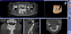Imagen de TAC de presentación de dos implantes